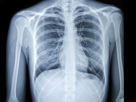  Chest X-rays may also be taken since this cancer commonly spreads to the lungs