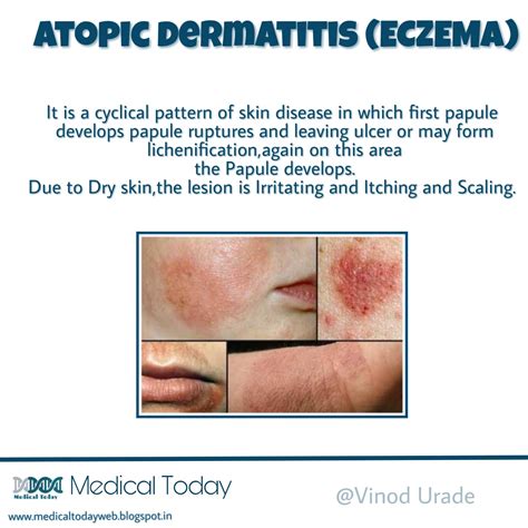  Common skin conditions include eczema or atopic dermatitis, skin fold dermatitis, interdigital pyoderma, and chin folliculitis