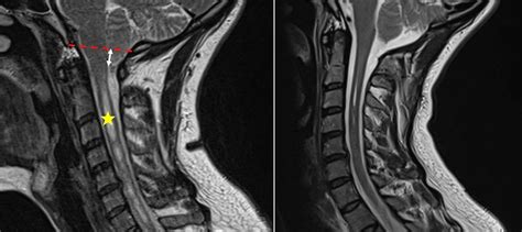  Commonly caused by cervical disk disease or Chiari-like malformation and syringomyelia, these events can be dramatic and intermittent, depending on the underlying cause