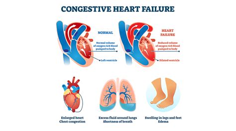 Congestive heart failure means that the leak across the heart valve overwhelms the heart and fluid goes from the heart backwards into the lungs instead of from the heart forward to the body