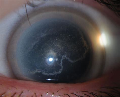  Corneal Dystrophy can be identified by symptoms such as formation of an opaque layer