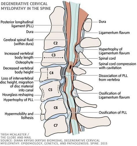  Degenerative Myelopathy: This is a progressive disease of the spinal cord