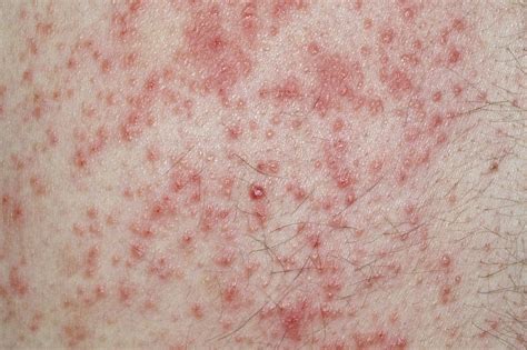  Dermatitis Dermatitis is an inflammation of the skin, usually due to some type of allergic response