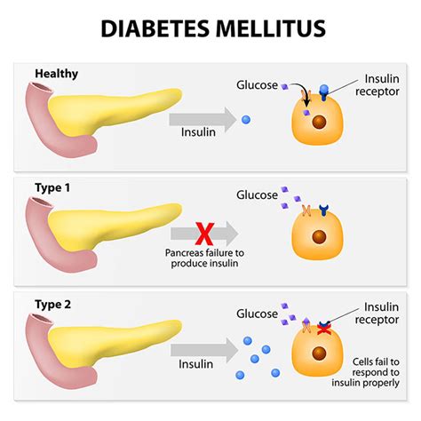  Diabetes Mellitus Diabetes mellitus can affect any breed but has an above-average occurrence in German Shepherds