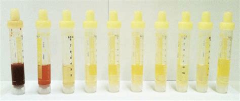  Dilution Dilution of urine samples takes many forms