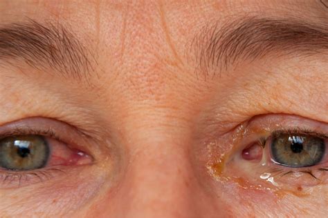  Discharge or Eye Buildup This could be indicative of infection or eye irritation