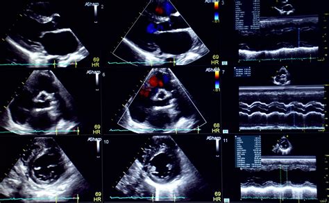  Echocardiogram heart examination, worth 1, USD We do echocardiogram on our Frenchies and when we find the slightest chance of heart murmur in one of them, we rather cancel the adoption and find a loving home for them locally