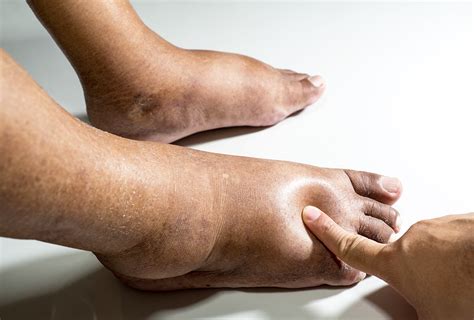  Edema is swelling caused by excess fluid trapped in your body