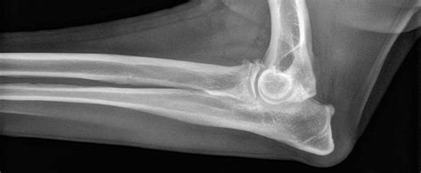  Elbow dysplasia: This is a similar condition that affects the elbow joint