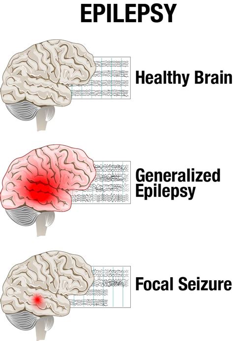  Epilepsy is typically categorized in two ways: Idiopathic epilepsy, also called primary epilepsy and symptomatic epilepsy