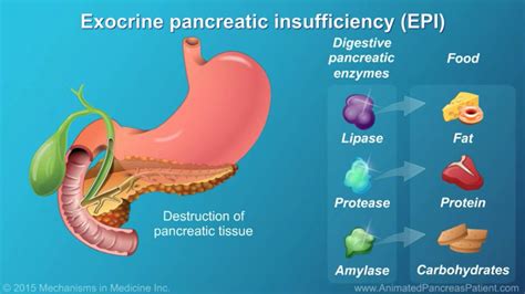  Exocrine Pancreatic Insufficiency EPI : This genetic pancreatic disorder diminishes digestive enzyme production, leading to impaired food digestion and absorption
