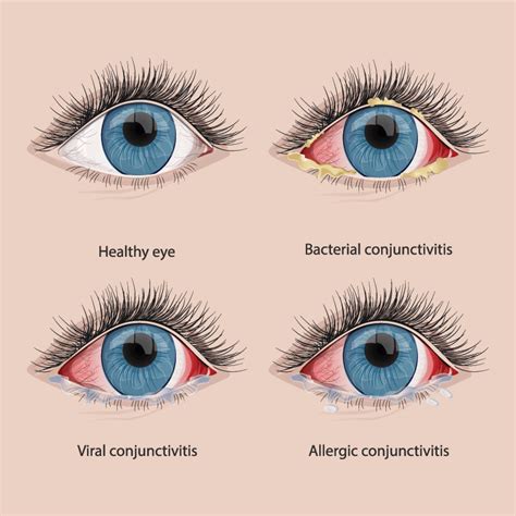  Eyes should be clear, with no redness or discharge