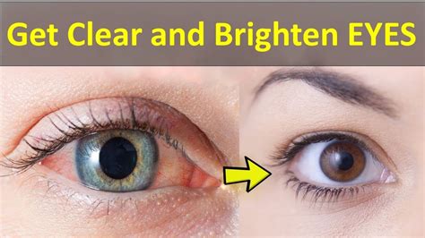 Eyes- The eyes should be clear and bright