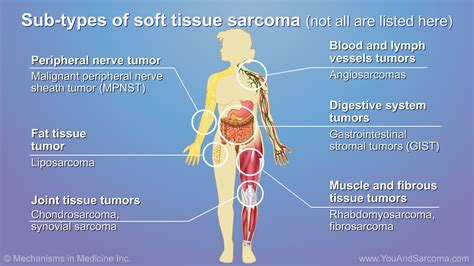  Fibrosarcoma is a prevalent type of soft tissue cancer that can affect many different parts of the body
