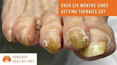  Fingernail clippings provide an overview of up to six months, with toenails providing an overview of up to 12 months