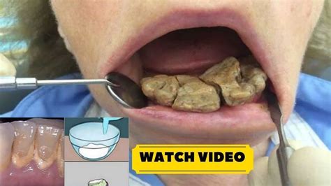  First, you need to remove tartar from your tongue and teeth
