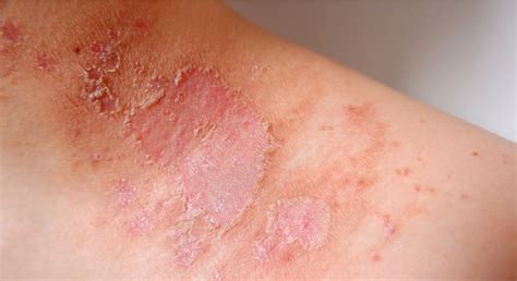  Fold Dermatitis — This occurs due to the moisture and heat that builds up in the folds of their skin