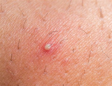  Folliculitis Folliculitis is another common problem that can occur after shaving