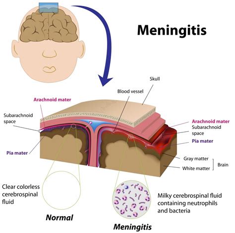  Fungal Meningitis: This type of meningitis is caused by fungal infection, with the most common pathogens being Cryptococcus neoformans and Histoplasma capsulatum