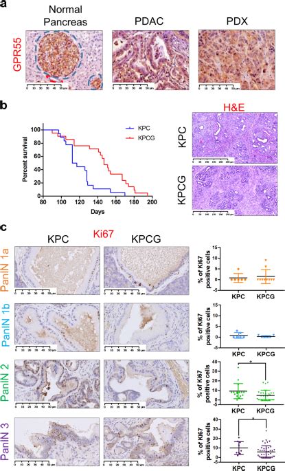  GPR55 signalling promotes proliferation of pancreatic cancer cells and tumour growth in mice, and its inhibition increases effects of gemcitabine