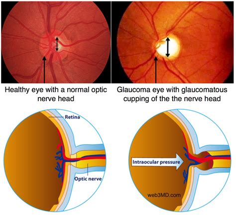  Glaucoma , by contrast, afflicts the optic nerve