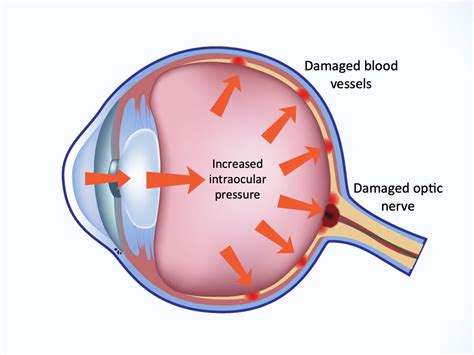  Glaucoma is caused by high pressure that builds up in the eye