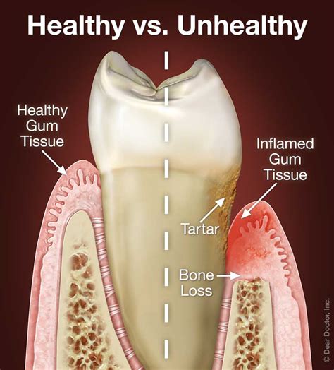  Gum Disease Periodontal Disease : Gum disease is caused by the buildup of plaque and tartar along the gumline, resulting in inflammation, redness, and swelling of the gums