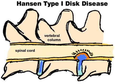  Hansen Type-I Disc Disease: Hansen type-I occurs when the gelatinous substance inside the disc hardens, eventually tearing the shell