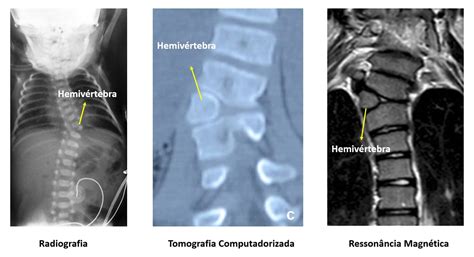  Hemivertebra can cause no problems, or it can put pressure on the spinal cord