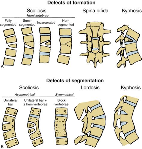  Hemivertebrae: Hemivertebrae is a condition that is characterized by a malformation of one or more vertebrae