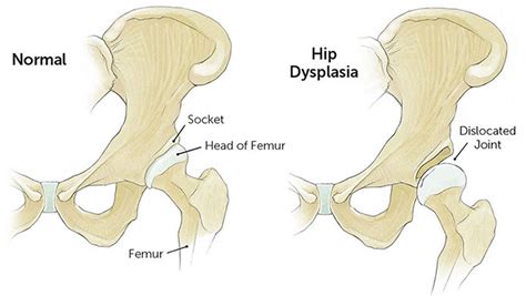  Hip Dysplasia: Hip dysplasia is a heritable condition in which the hip joint is improperly formed, leading to poor fit between the thighbone and hip socket