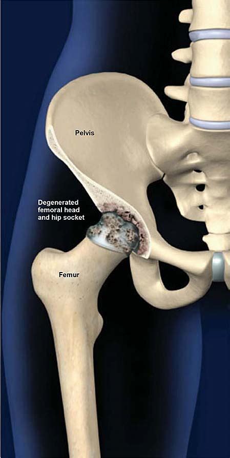  Hip dysplasia is a condition that affects the hip joints and can cause pain and lameness