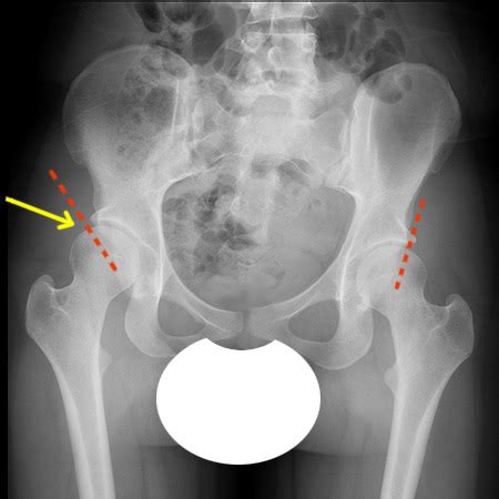  Hip dysplasia is a genetic condition that occurs due to uneven growth of the hip joints