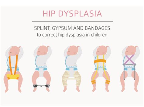  Hip dysplasia is hereditary, and not much can be done to prevent it entirely