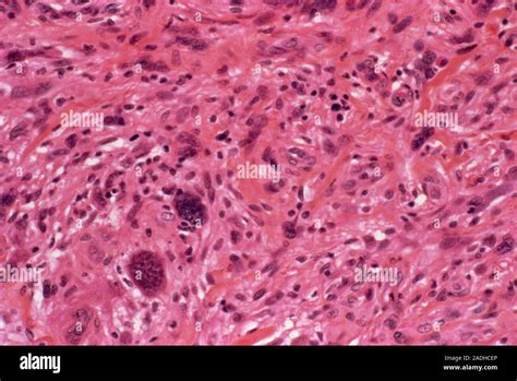  Histiocytoma: This tumor affects skin cells known as histiocytes which actually form part of the immune system