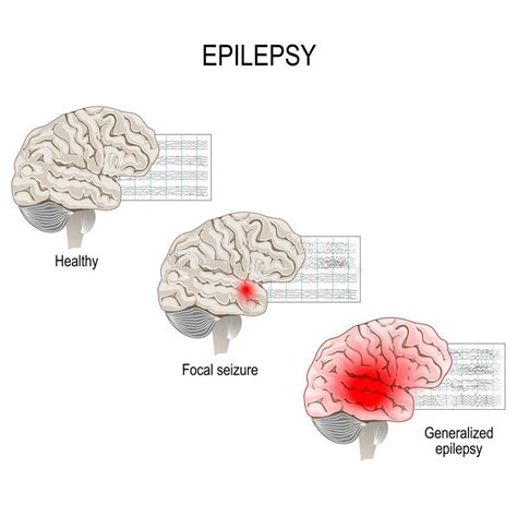  Idiopathic epilepsy has no identifiable cause and is often a genetic issue, while symptomatic epilepsy occurs when there is an identifiable underlying brain lesion or metabolic cause, like the ones mentioned above