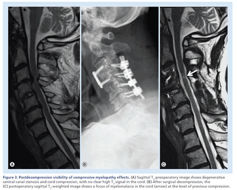 If compression of the spinal cord does occur, advanced imaging techniques such as myelography, CT scans, or MRIs are usually required to diagnose it