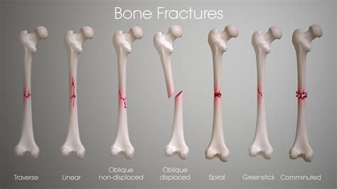  If left undiagnosed, fractures in this area will almost always occur