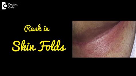  If the folds are not cleaned regularly and properly, it can lead to infection and a disease called skin fold dermatitis