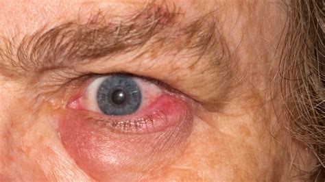  If the gland is sore or swollen, it looks like a red blob in the corner of the eye