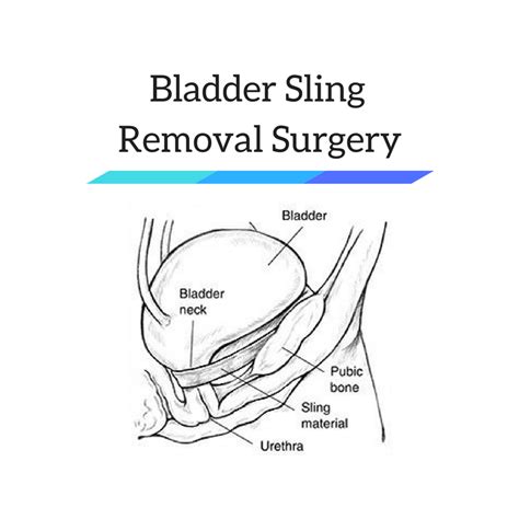  If the tumor is not near the opening or exit of the bladder, surgical removal is possible