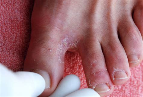  If you notice redness between the toes, then it is likely yeast