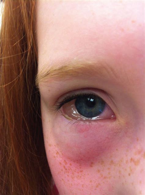  In some cases, the eye itself will seem red, itchy, or swollen