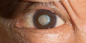  Incipient cataracts may even require magnification to diagnose and typically do not require surgery