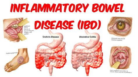  Inflammation of the small intestine enteritis and colon colitis are examples of IBD