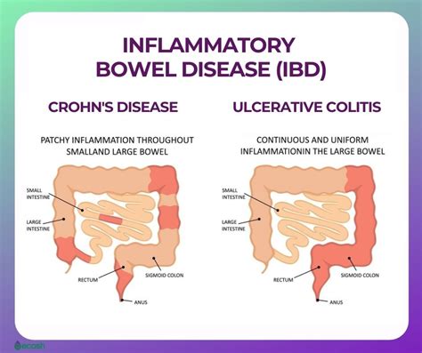  Inflammatory Bowel Disease Inflammatory Bowel Disease or IBD is an immune system disorder common in French Bulldogs in which the intestinal lining becomes overrun with immune system cells called lymphocytes and plasmacytes