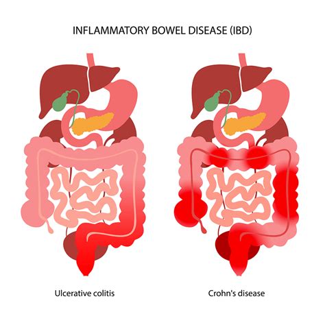  Inflammatory Bowel Disease Inflammatory bowel disease, or IBD, is an immune system disorder common in Boxers in which the intestinal lining becomes overrun with immune system cells called lymphocytes and plasmacytes