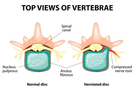  Intervertebral Disc Disease Diagnosis Sudden lethargy or inability to lift the head can be a sign of intervertebral disc disease in French Bulldogs