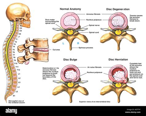  Intervertebral Disc Disease Intervertebral disc disease is a degenerative condition that affects the cartilaginous discs in the spinal column