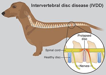  Intervertebral disc disease IVDD is one example that can actually result in paralysis
